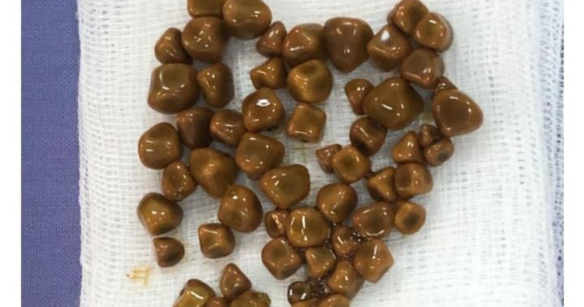 Phát hiện 56 viên sỏi đều tăm tắp trong túi mật một nữ bệnh nhân