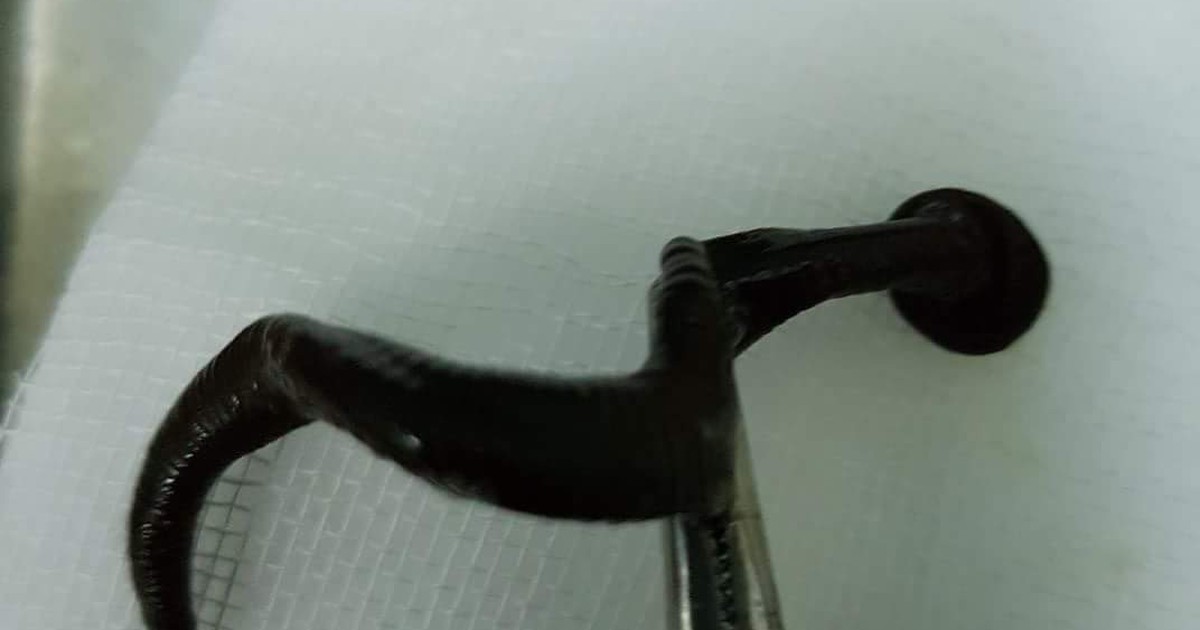 Gắp con đỉa dài 15 cm ra khỏi hốc mũi một bệnh nhi