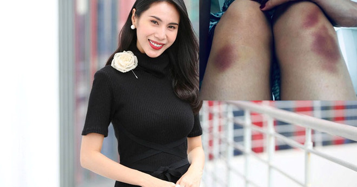 Ca sĩ Thủy Tiên ngã chấn thương khi tập vũ đạo