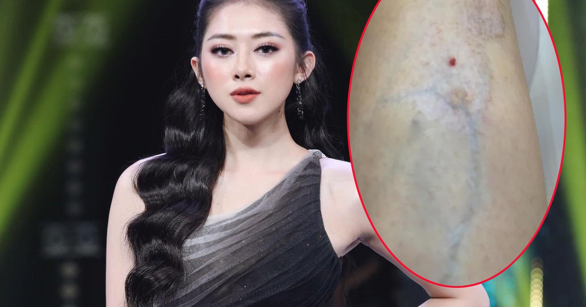 Hot girl 'Người ấy là ai' bị teo cơ, giãn tĩnh mạch do tiêm thẩm mỹ sai cách