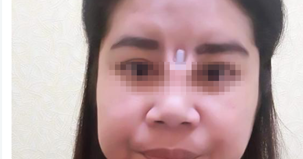 Sau nâng mũi, thấy miếng silicon lồi ra trên... mặt