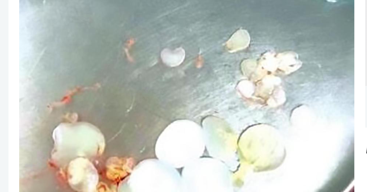 Lấy hơn 30 trứng sán và ấu trùng ra khỏi não của bệnh nhân