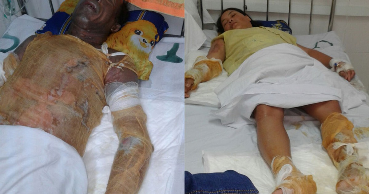 Hai vợ chồng bị bỏng nặng không tiền chữa trị
