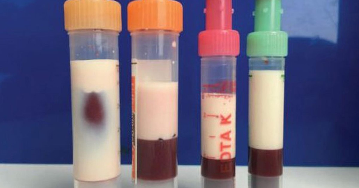 Bác sĩ cũng sốc: Máu của bệnh nhân chuyển sang màu... trắng sữa