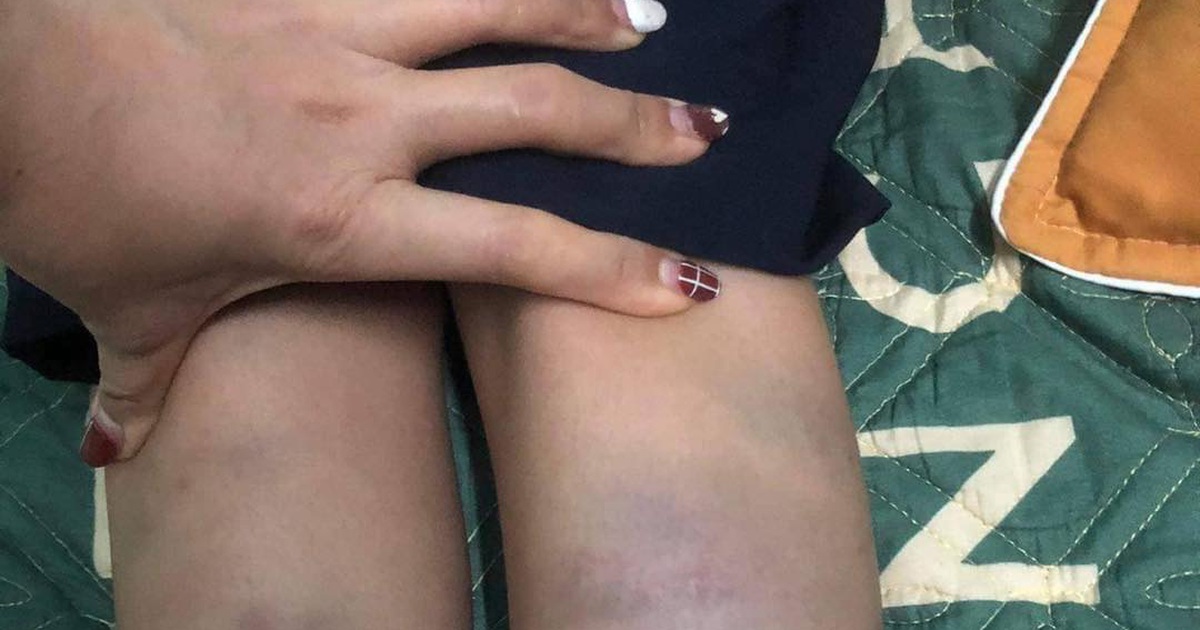 Đà Nẵng: Học sinh lớp 1 đi học về bị bầm tím tay chân do bạn đánh