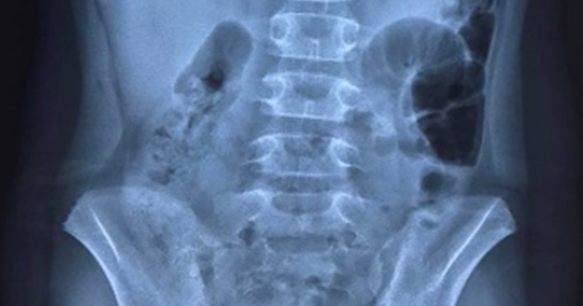 Cảnh báo nguy cơ thủng dạ dày ở trẻ nhiễm Covid-19 do dùng thuốc không đúng cách