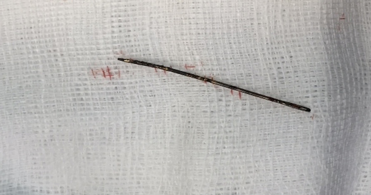 Phẫu thuật lấy cây kim khâu gỉ sét trong lồng ngực bé gái