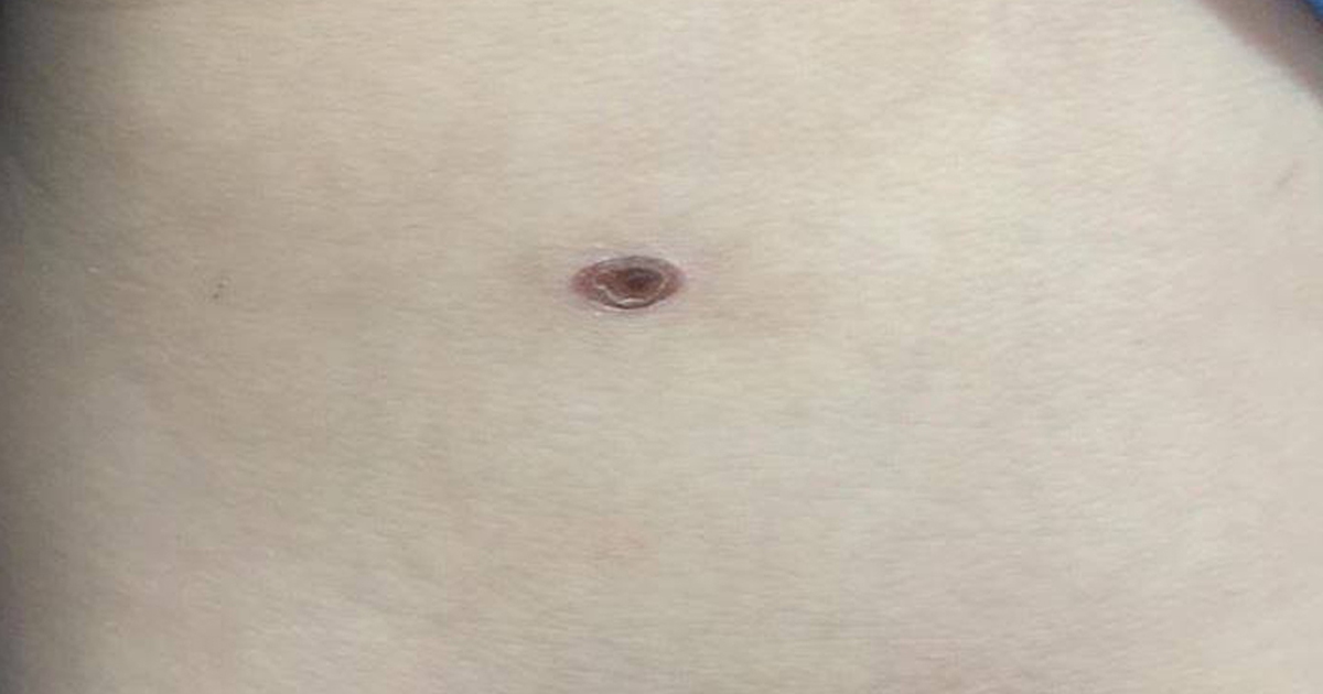 Cảnh giác với 'sốt mò' ở trẻ nhỏ