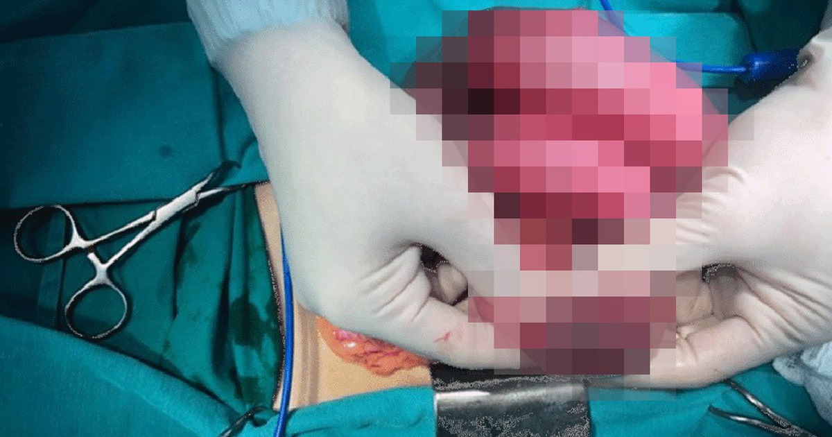 Nam thanh niên bị tắc ruột sau khi thường xuyên uống trà sữa, bỏ cơm