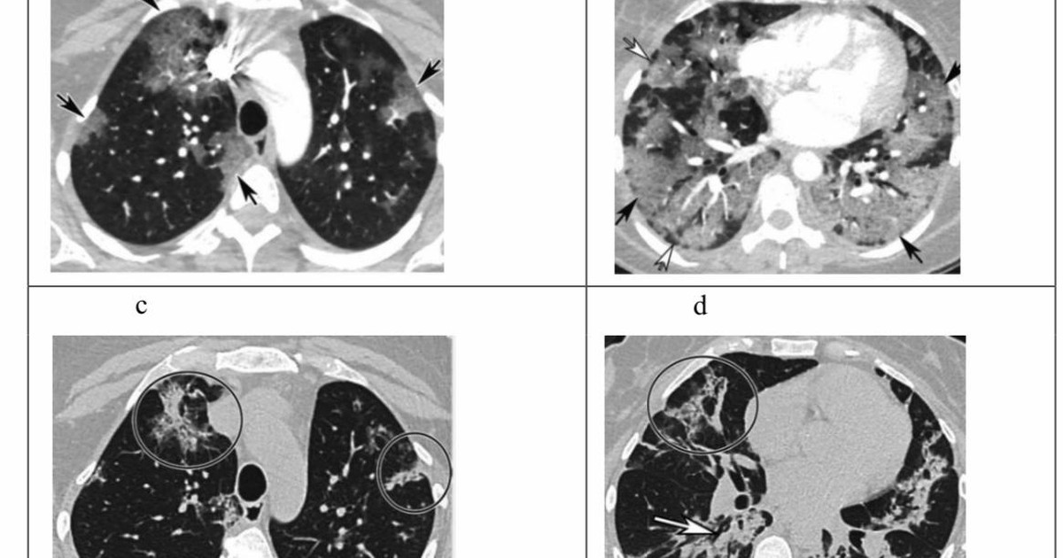 Biến thể Omicron có thể lây lan nhanh hơn Delta 500%