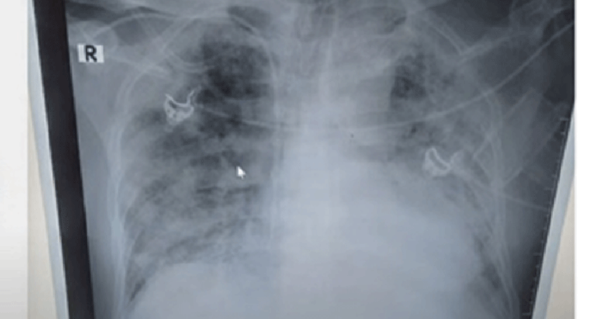 Tăng cường phát hiện, quản lý ca bệnh Covid-19