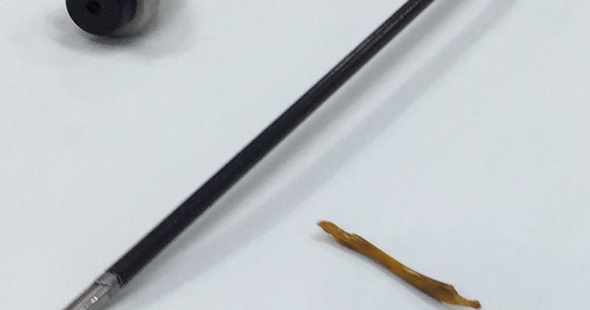 Mổ lấy ra xương cá đâm thủng đại tràng bệnh nhân