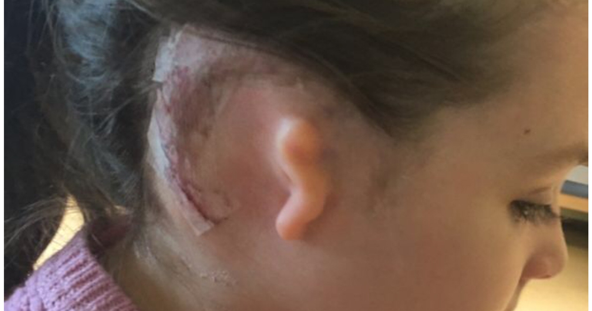 Cô bé sinh ra chỉ có một tai hạnh phúc vì đã nghe được