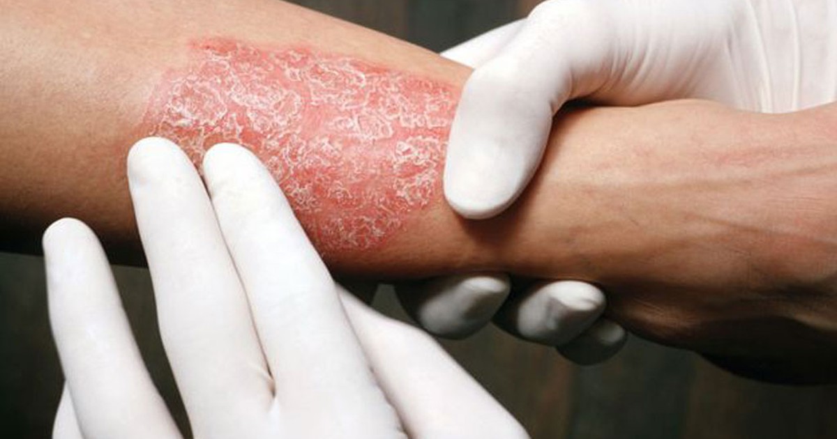 Bệnh vẩy nến nghiêm trọng làm tăng rủi ro tiểu đường