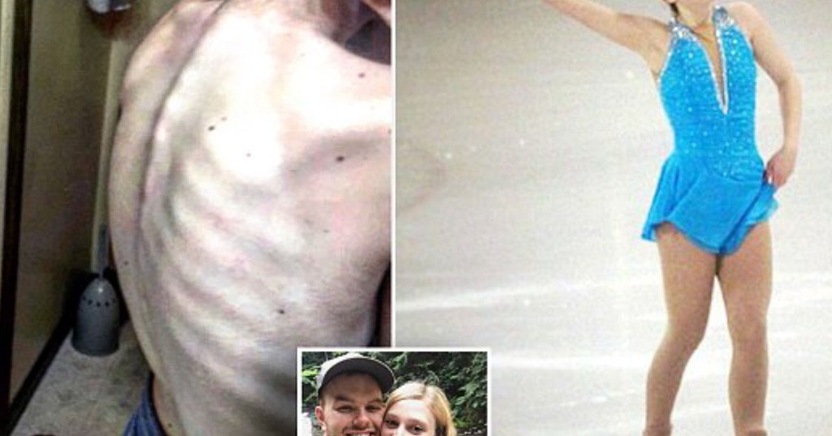 Cô gái suýt chết vì chỉ ăn 'một quả táo mỗi ngày'