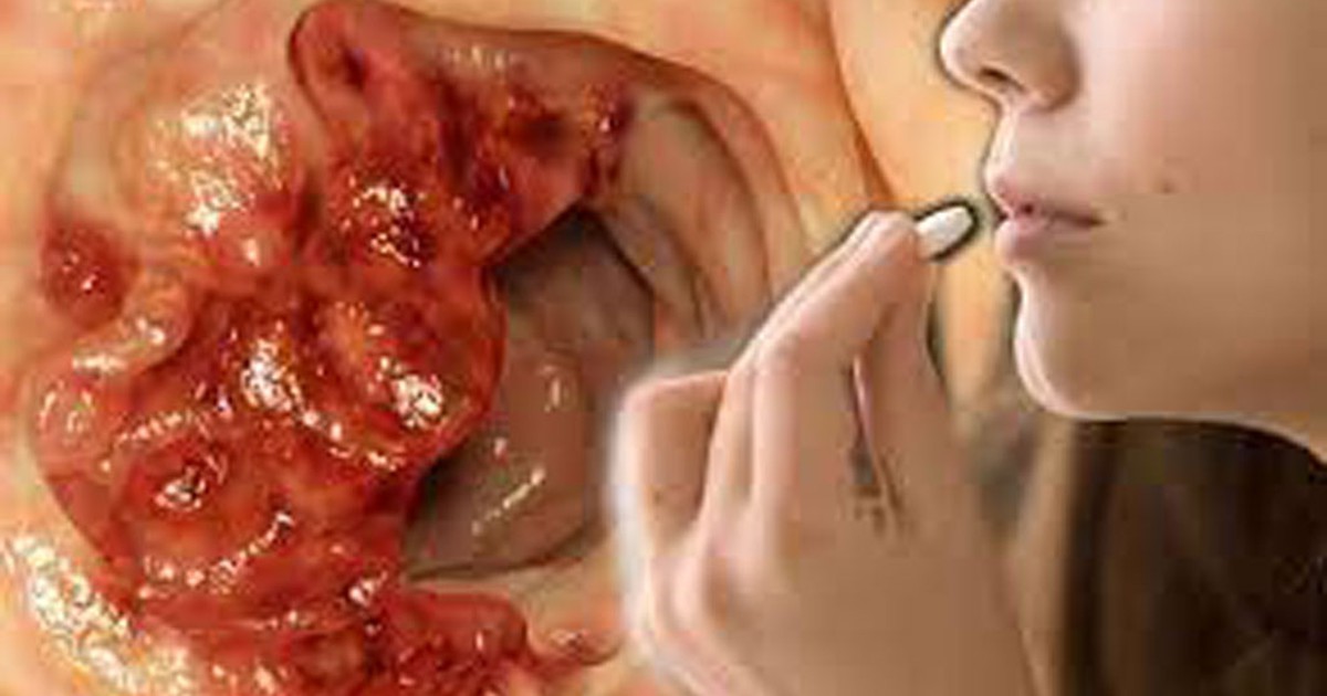 Những yếu tố làm tăng nguy cơ gây ung thư ruột