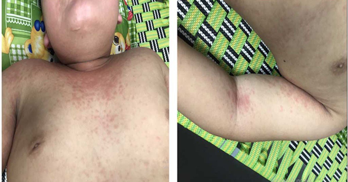 Bé trai chuẩn bị xuất viện thì bị viêm đa hệ thống hậu Covid-19