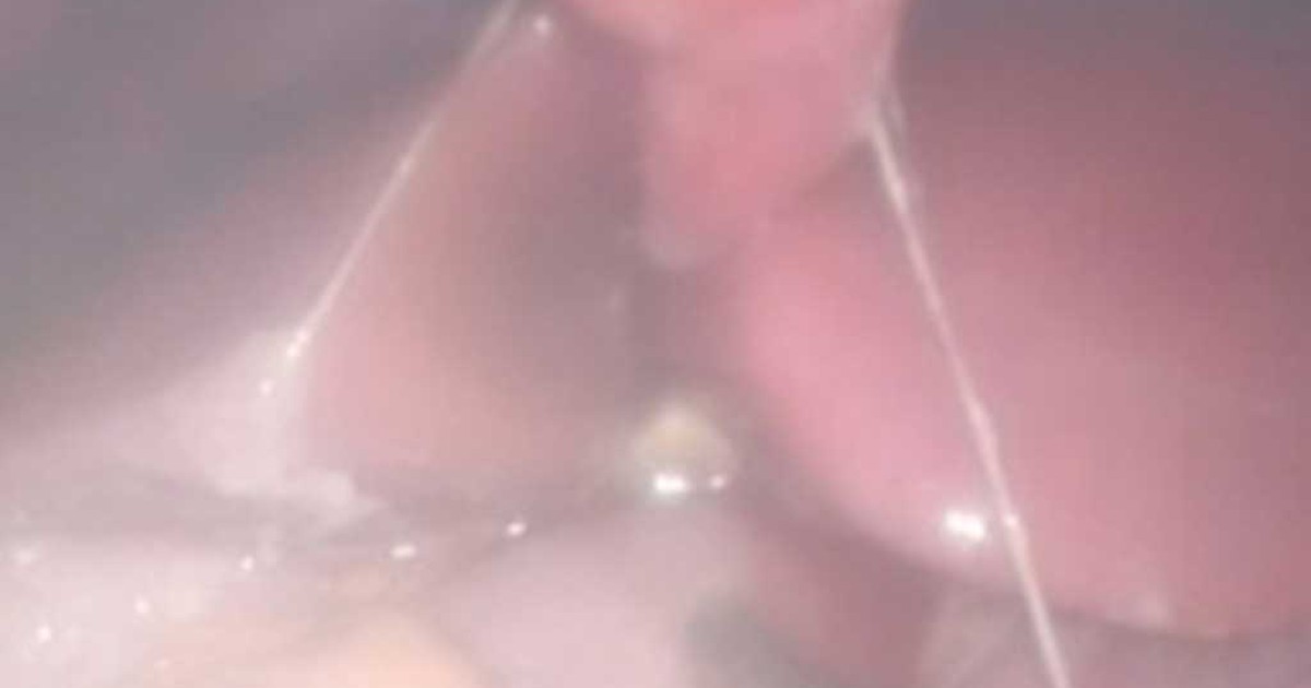 Nguy cơ trẻ nhiễm Covid-19 bị thủng dạ dày nếu dùng thuốc sai cách