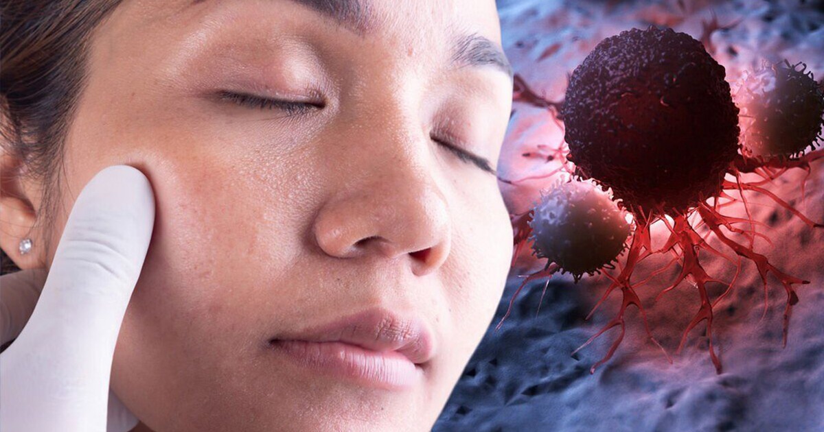 Dấu hiệu lạ xuất hiện trên mặt cảnh báo sớm ung thư dạ dày