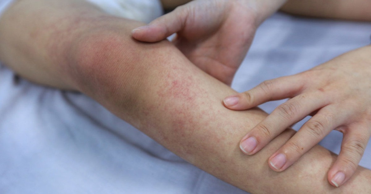 Không dùng thuốc Aspirin và Ibuprofen cho người bị sốt xuất huyết