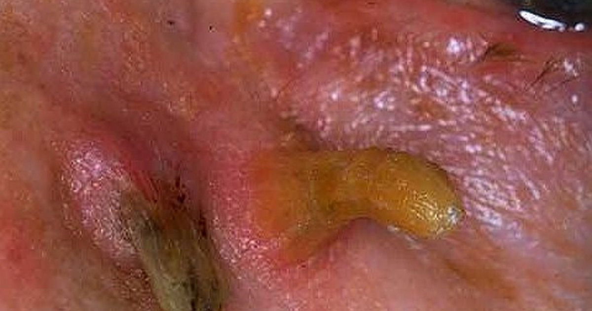 Kỳ quái người đàn ông mọc sừng trên đầu 'cậu nhỏ', cắt đi lại mọc tiếp