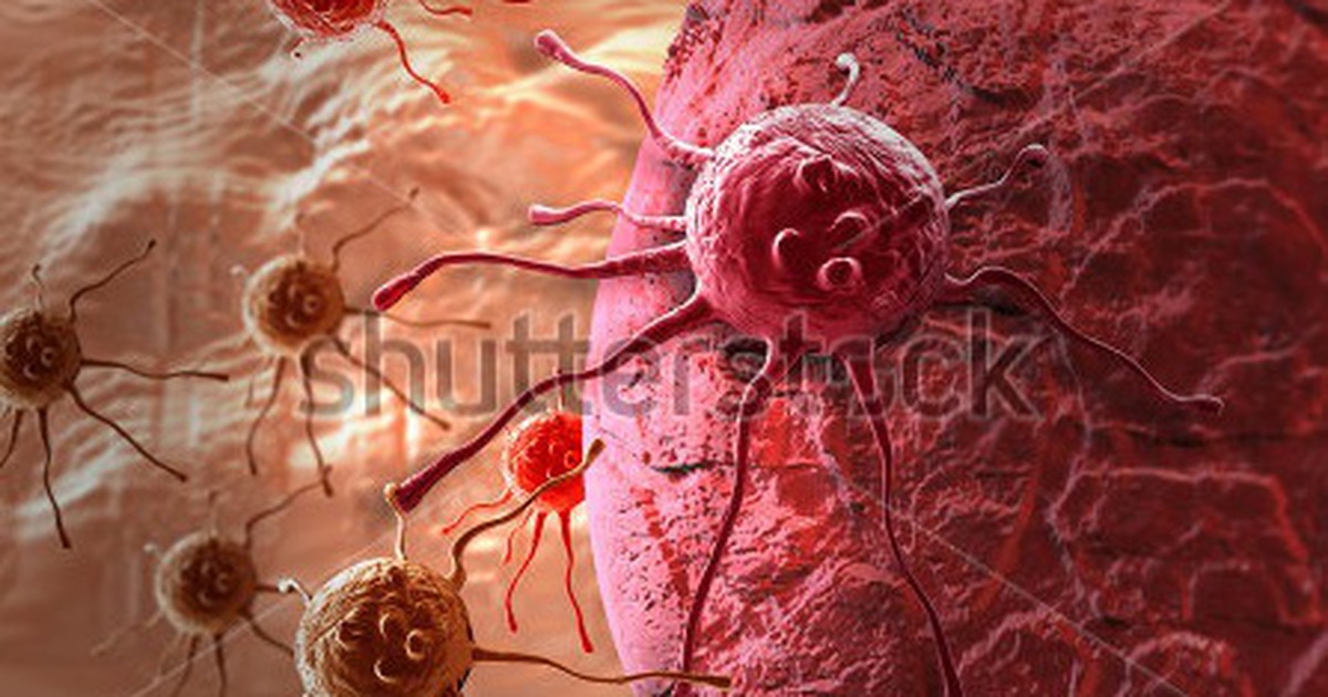 Ung thư buồng trứng: Hóa trị trước phẫu thuật cho kết quả tốt hơn