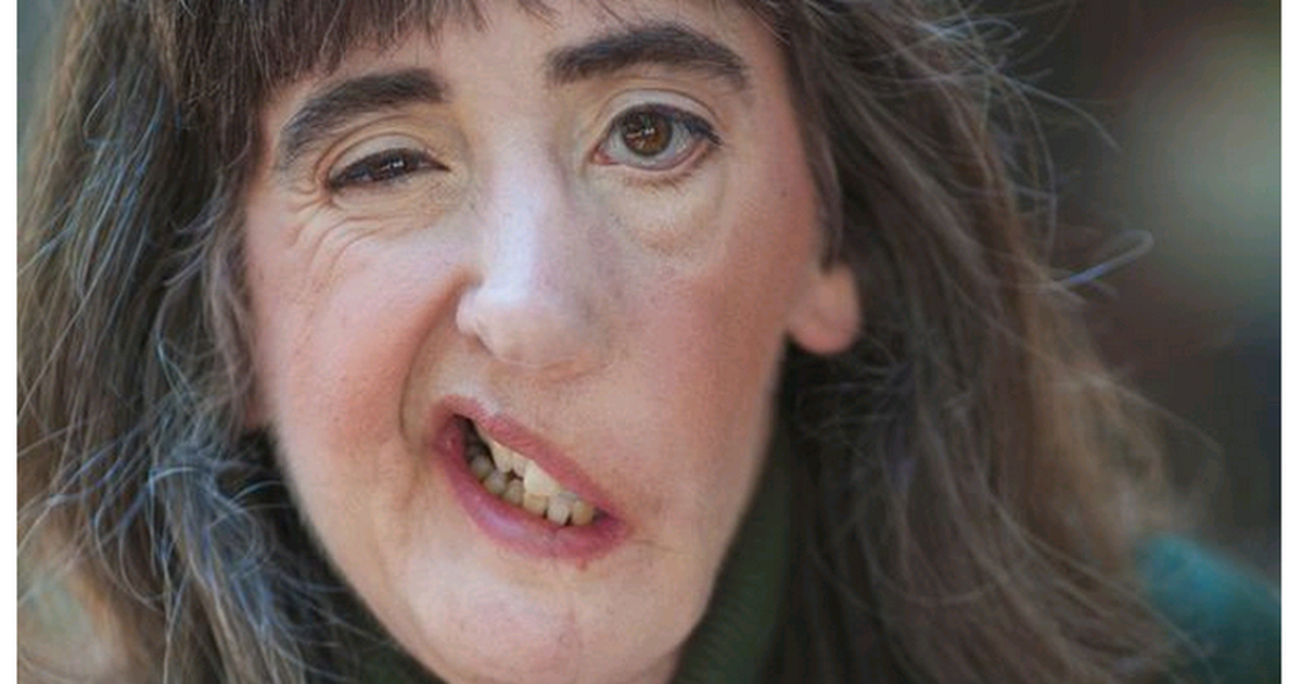 Người phụ nữ Mỹ bị cắt bỏ gần nửa gương mặt