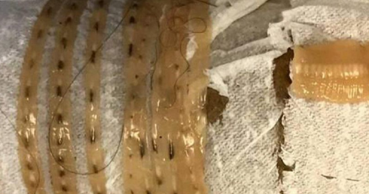 Bệnh nhân ‘kéo’ con sán dây dài gần 1,7 mét ra khỏi cơ thể