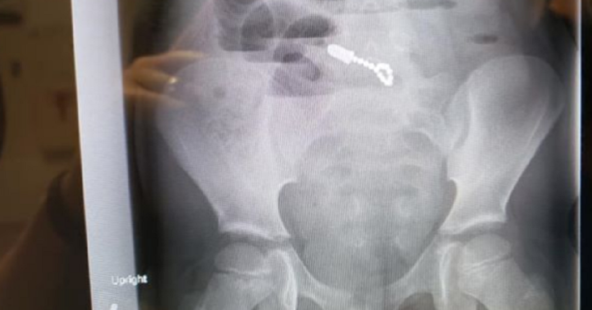 Cậu bé giấu đồ chơi trong miệng rồi nuốt luôn 14 viên nam châm