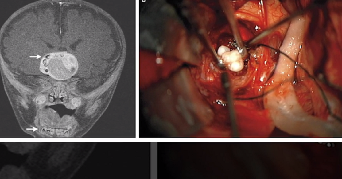 Khối u kỳ lạ mọc răng trong não cậu bé