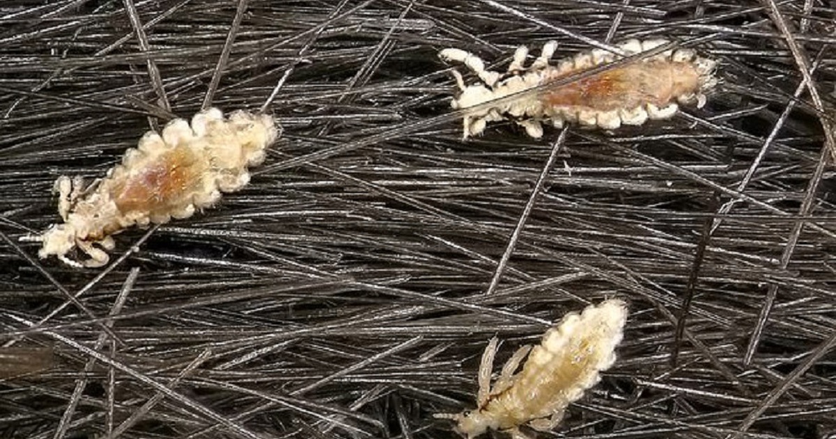 Người mẹ trẻ bị bắt vì con 4 tuổi bị chấy cắn suýt chết