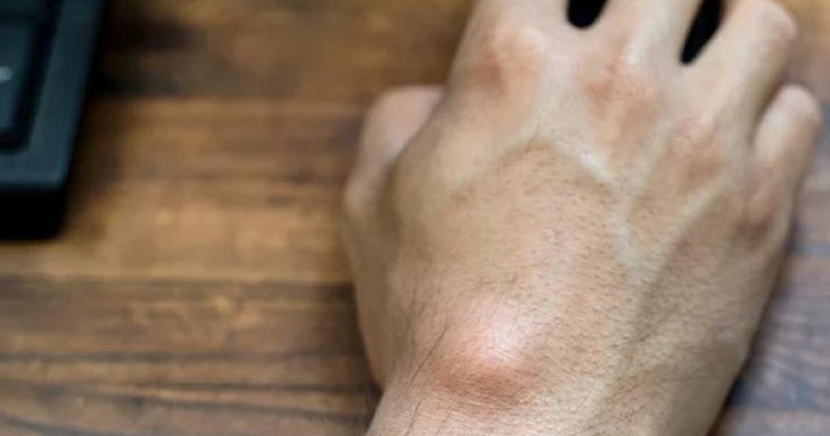 Điều gì sẽ xảy ra nếu các khối u nang không được điều trị?