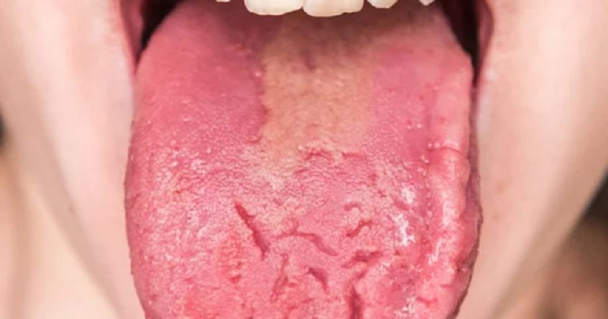 Lưỡi bị nứt