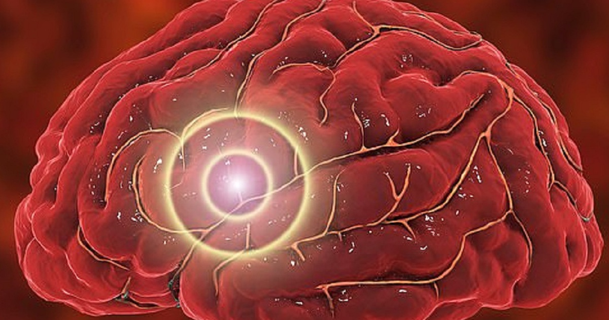 Bị đột quỵ, chàng trai thay đổi giọng nói như người máy