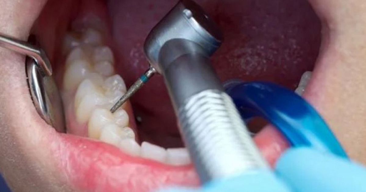 Đi trám răng, người đàn ông hít mũi khoan nha khoa vào phổi