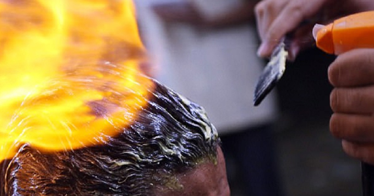 Dùng lửa để tạo kiểu tóc, nam thanh niên nhập viện vì bỏng nặng