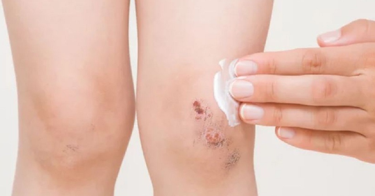 Bị rách da, để khô thoáng liền mài hay băng lại sẽ tốt hơn?