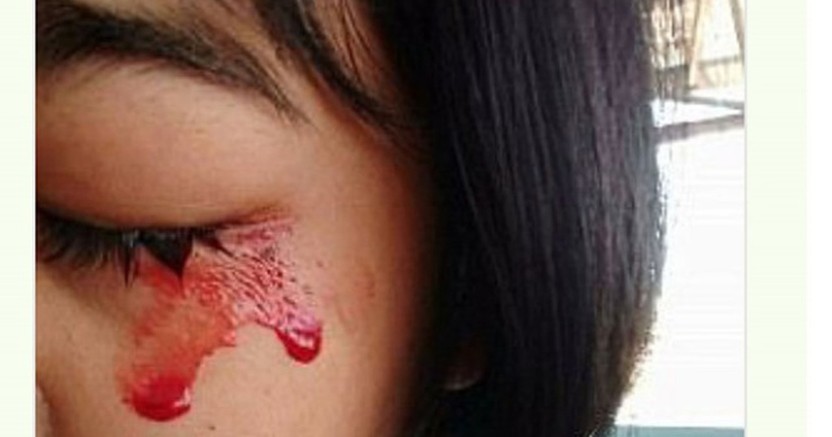 'Mồ hôi máu' - căn bệnh kỳ bí đối với y khoa thế giới