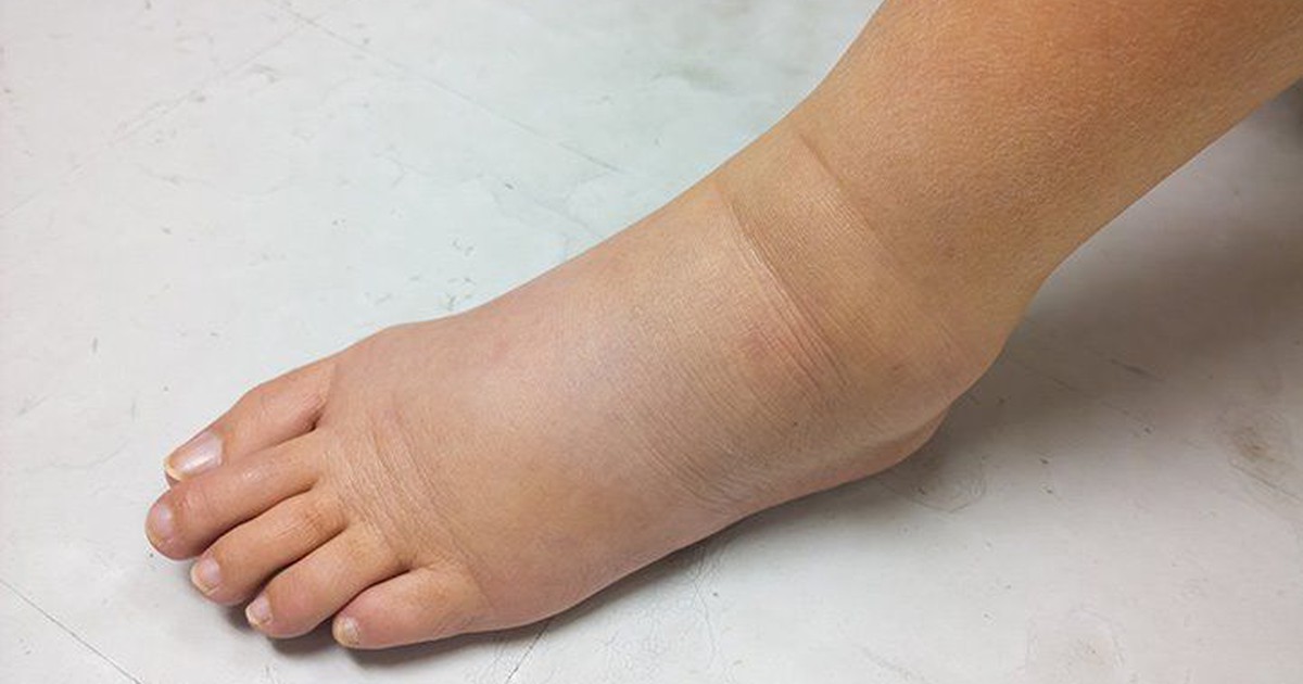 Thường xuyên bị phù chân là dấu hiệu nguy hiểm của bệnh gì?