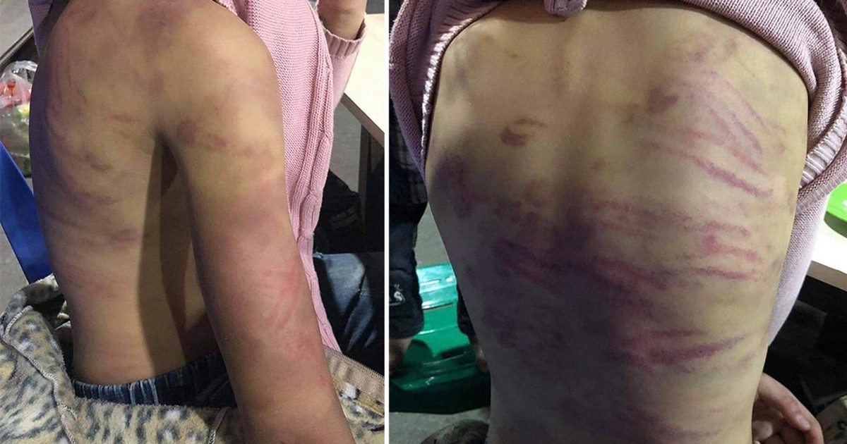 Phẫn nộ việc bé gái 'tố' bị mẹ bạo hành, nhân tình của mẹ xâm hại