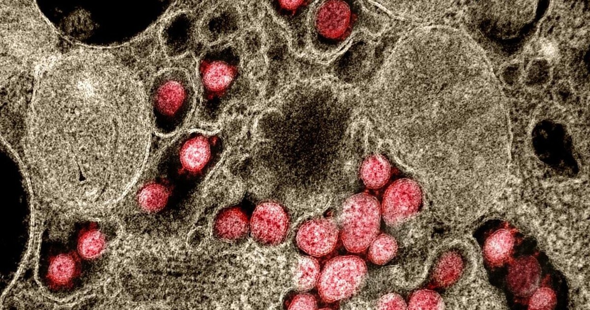 Phát hiện mới: Triệu chứng hậu Covid-19 khác nhau ở từng biến thể