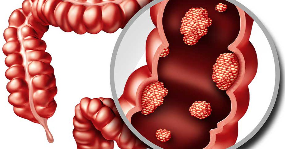 Phát hiện mới: Tập thể dục giúp giảm nguy cơ mắc ung thư