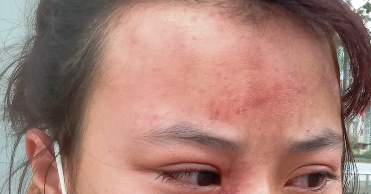 Khởi tố người đàn ông hành hung nữ sinh lớp 10 đến chấn động não