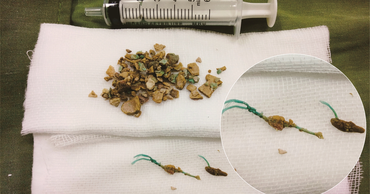 Phẫu thuật lấy ra sợi chỉ trong bọng đái một phụ nữ