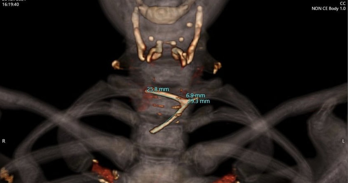 Mảnh xương gà hình chữ Y 3 cạnh nhọn mắc kẹt trong thực quản