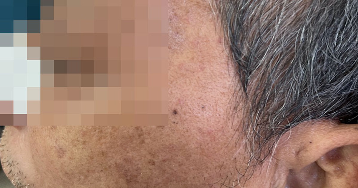 Các triệu chứng thường gặp ở người bệnh hoại tử xương sọ mặt