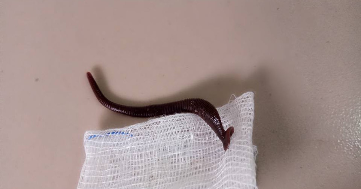 Gắp con vắt dài 5 cm ra khỏi hốc mũi bé gái