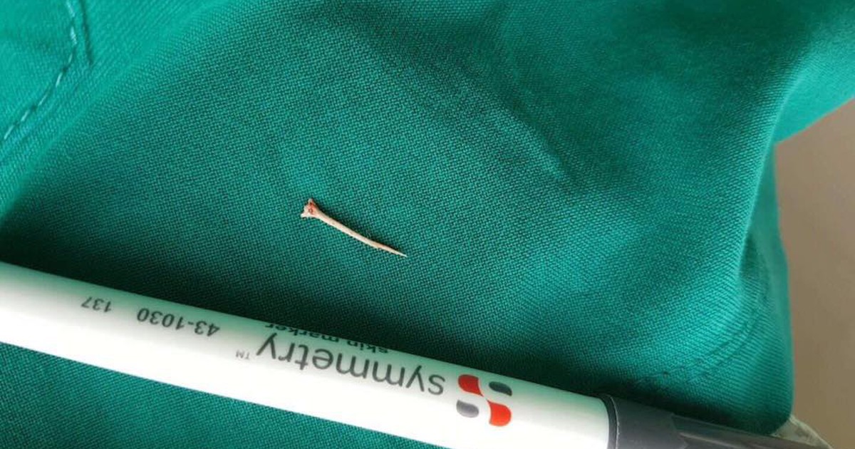 Mổ gắp mẩu xương cá đâm xuyên thành thực quản, uy hiếp tính mạng bệnh nhân