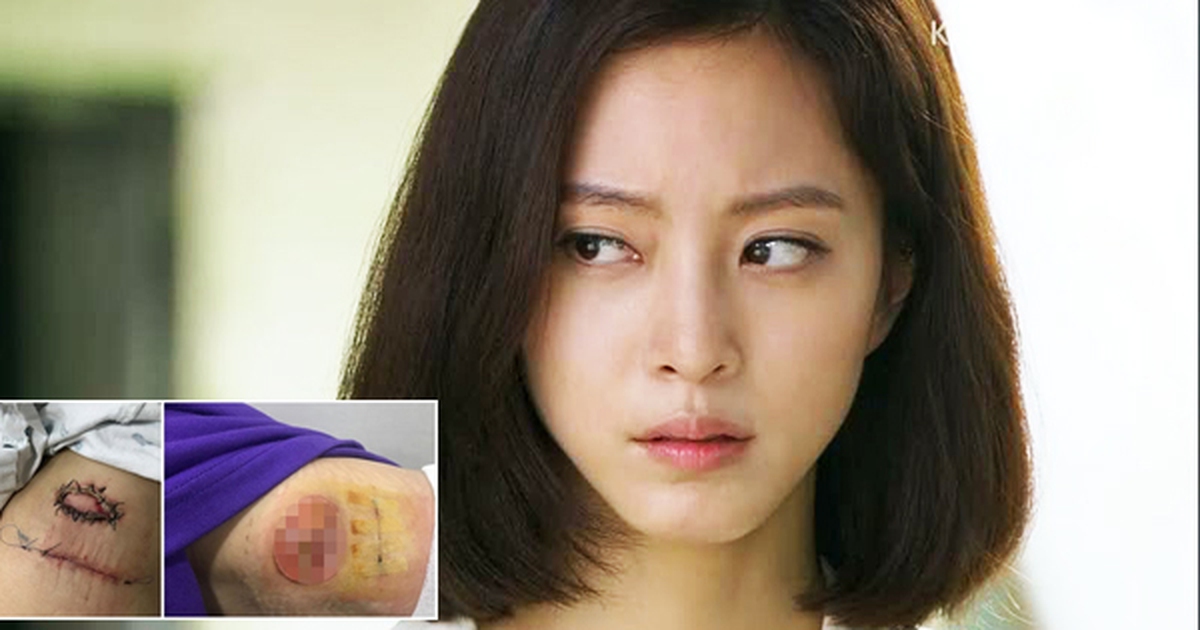 Mỹ nhân Han Ye Seul bị lở loét sau phẫu thuật