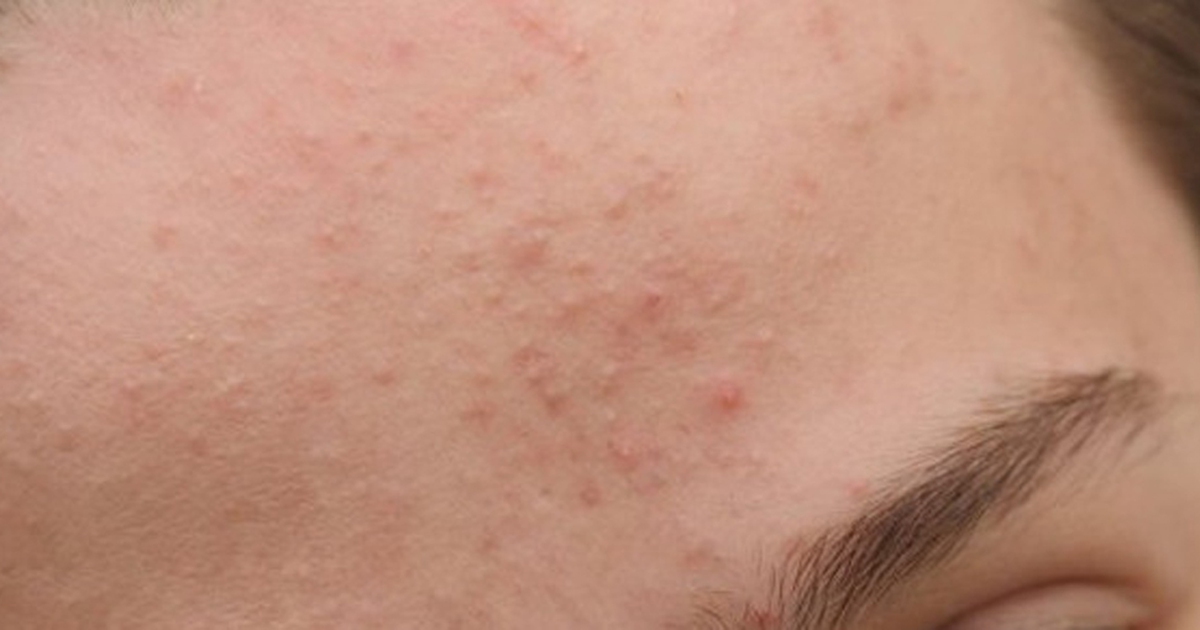 Cách chăm sóc da để ngăn ngừa và điều trị mụn ẩn